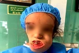جراحی کم‌سابقه پزشکان ایرانی برای نجات کودک سرطانی