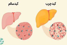 برای کبد چرب چی بخوریم