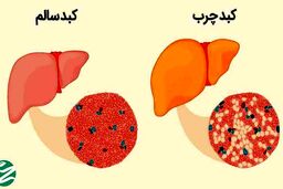 برای کبد چرب چی بخوریم