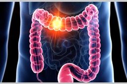 پیشگیری از سرطان روده بزرگ با راهکاری ساده