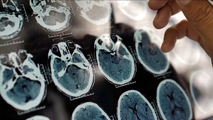 یک عامل مهم و کمتر گفته شده درباره روند پیشرفت آلزایمر

