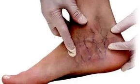 توصیه مهم برای پیشگیری از واریس